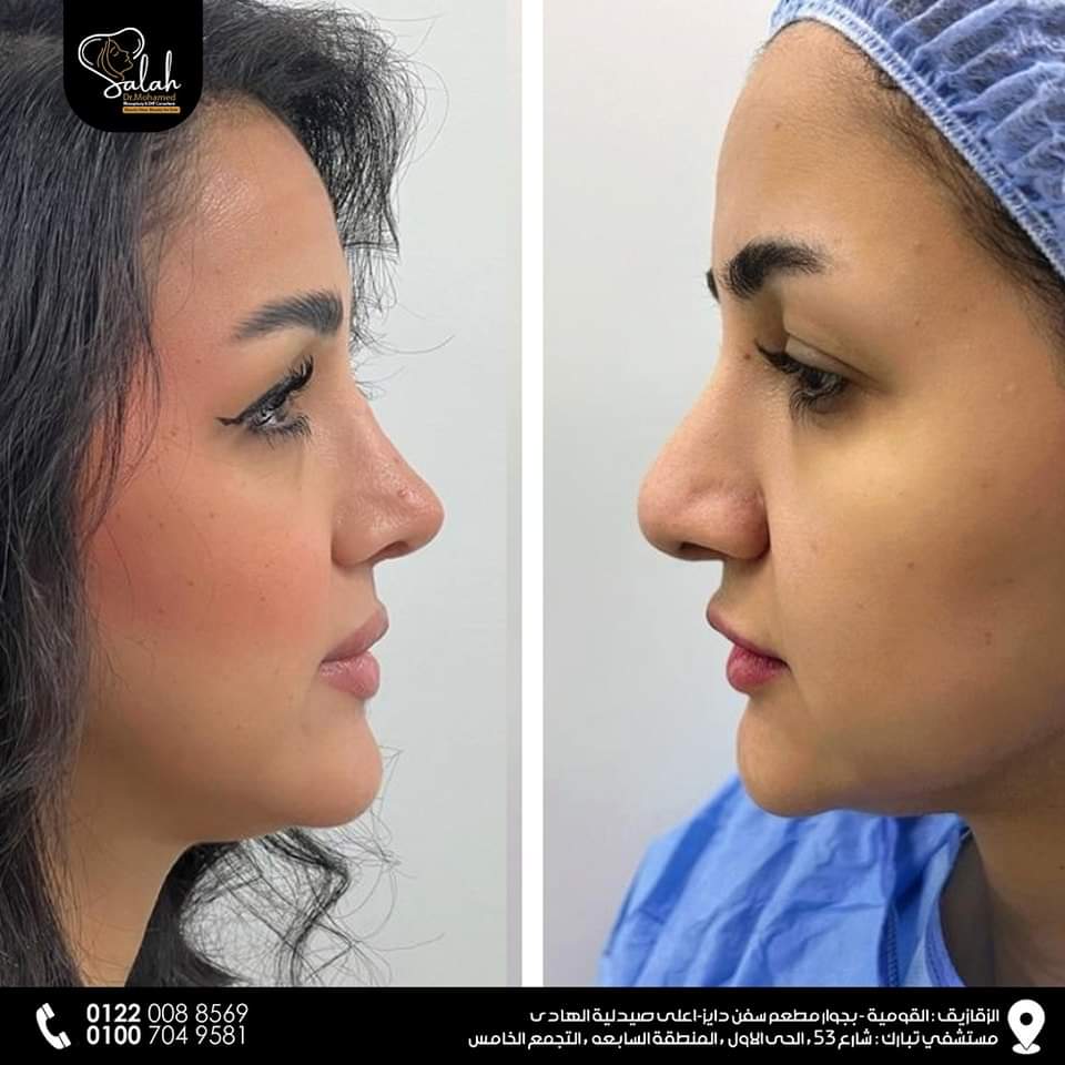 Bulbous Tip Rhinoplasty